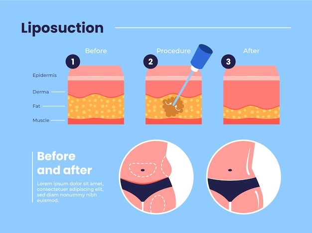 hand-drawn-flat-design-liposuction-infographic_23-2149329309